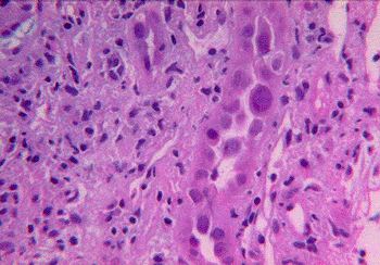 Image: The BK virus in renal epithelial cells (Photo courtesy of the College of American Pathologists).